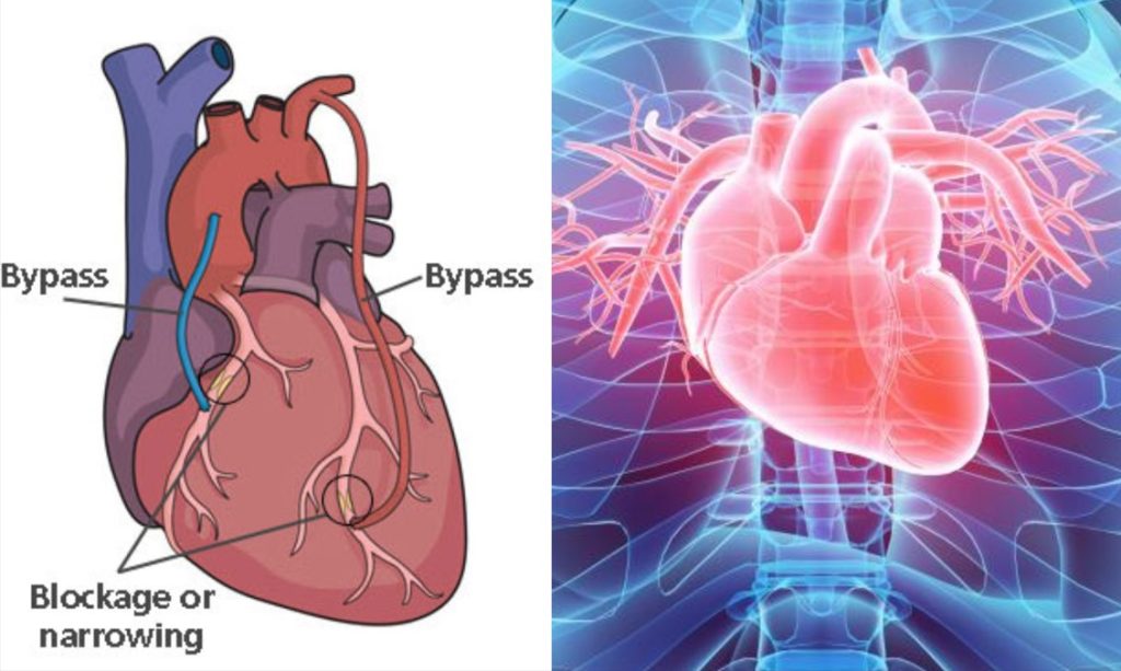 Bypass surgery